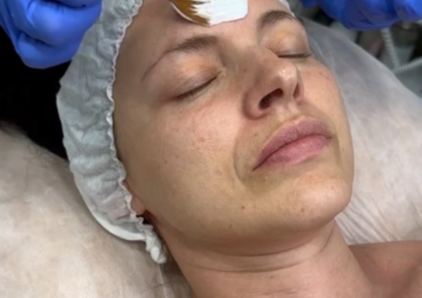 Odos atjauninimo procedūra su radijo dažniu ir drėkinančia kauke